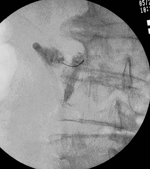 Frontal fluoroscopy view after injection of contrast medium. The needle is positioned at the exit zone of the left, L3–L4 intervertebral foramen.