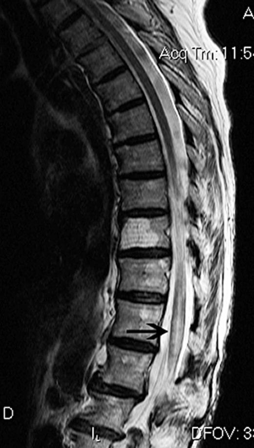 Sagittal magnetic resonance imaging taken 2 days after a left, L3 transforaminal injection of particulate corticosteroids, showing infarction (black arrow) of the lower thoracic spinal cord.