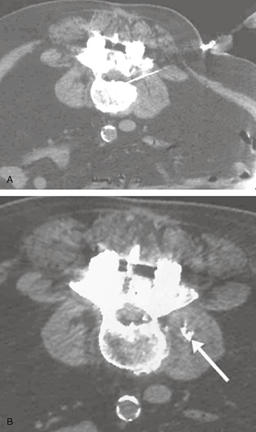 Prone Axial CT views of right L3 trasnforaminal injection. (A) The needle tip lies against the vertebral body in the midzone of right L3–L4 intervertebral foramen prior to injection. The next section documented that the needle tip was immediately below the pedicle, in the anterior superior aspect of the root canal. (B) After injection, some contrast medium is seen in the lateral recess or entrance zone of L3 root canal. Contrast medium is also seen in the extraforaminal zone and in the surrounding neurovascular structures (white arrow) in the right psoas muscle.