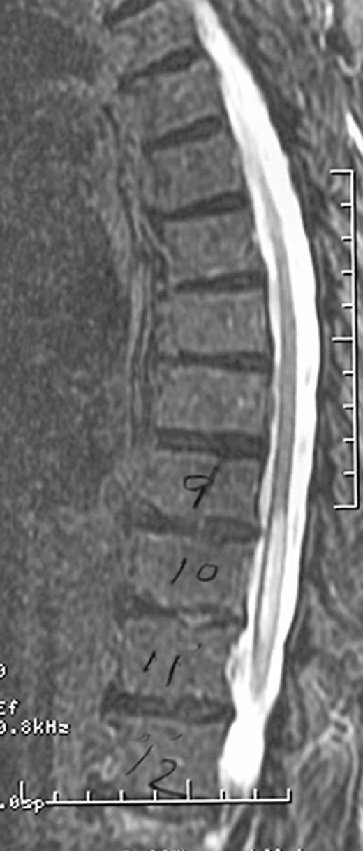 Thoracic magnetic resonance imaging, midsagittal section acquired 2 days after an L3 transforaminal steroid injection of particulate corticosteroids. Bright signal in the central cord represents part of a long distal thoracic cord and conus infarct.