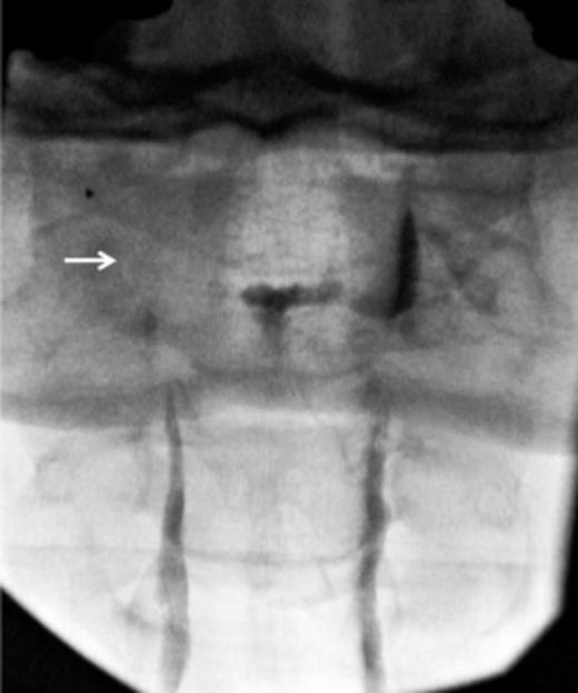Spinal headache Spinal headache