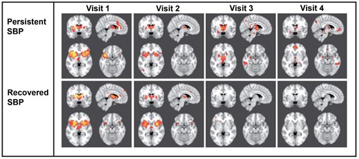 Longitudinal changes in brain activity underlying spontaneous pain when patients transition from an acute to a chronic back pain state (used with permission from Hashmi et al. [64]). At visits 1 and 2, recovering and persistent subacute back pain (SBP) groups show activation within acute pain regions including the bilateral insula, thalamus, and anterior cingulate cortex. At visits 3 and 4, patients recovering from SBP show no significant activity, whereas increased activation in the medial prefrontal cortex and amygdala is observed in patients with persistent SBP at visit 4.