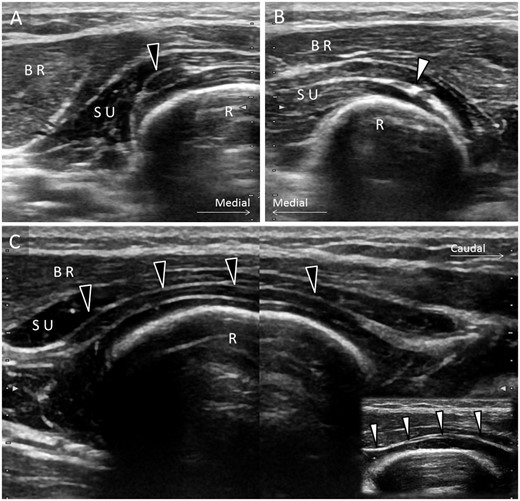 Comparative ultrasound imaging showing (A) the swollen deep branch of the radial nerve (black arrowhead) in the short axis view with a maximal diameter of 1.7 mm. B) Normal size of the nerve (white arrowhead) is seen on the asymptomatic side with a maximal diameter of 0.6 mm. C) On the split-screen view, significant enlargement (black arrowheads) with a maximal diameter of 1.8 mm is again visualized in the long axis of the nerve when compared with the nerve (white arrowheads) with a maximal diameter of 0.7 mm on the healthy side (inset). BR = brachioradialis muscle; R = radius; SU = supinator muscle.