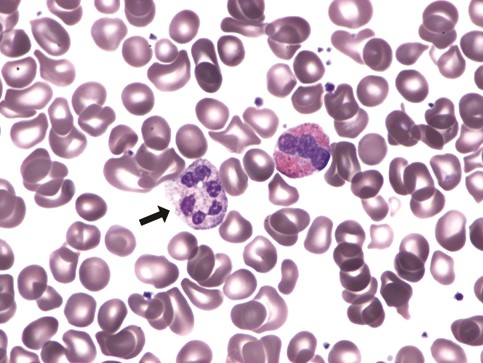 Peripheral blood smear demonstrating a hypersegmented neutrophil