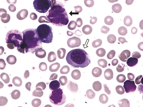Bone marrow aspirate demonstrating megaloblastic hematopoiesis with a megaloblast (white arrow) and a giant metamye-locyte (black arrow)