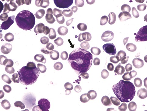 Bone marrow aspirate demonstrating megaloblastic hematopoiesis with a giant metamyelocyte (black arrow)