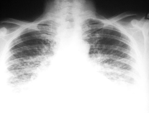 Radiograph showingcardiomegaly and pulmonary oedema.