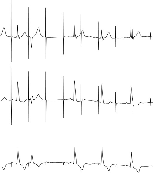 ECG showing failure to capture.