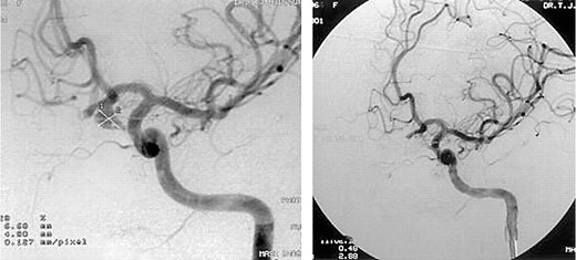 In the same patient as in fig 2, the cerebral angiogram demonstrates the aneurysm before treatment (left) and after successful embolisation (right).