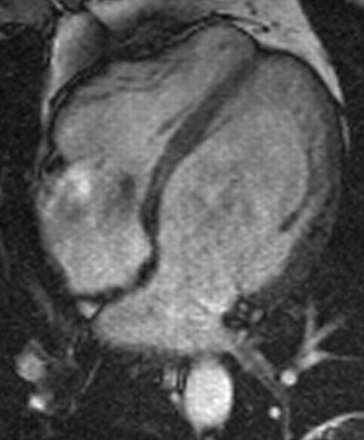 A four chamber view of the heart during diastole. A series of these images at different levels can be used to calculate the systolic and diastolic volume of the heart and so estimate ejection fraction.