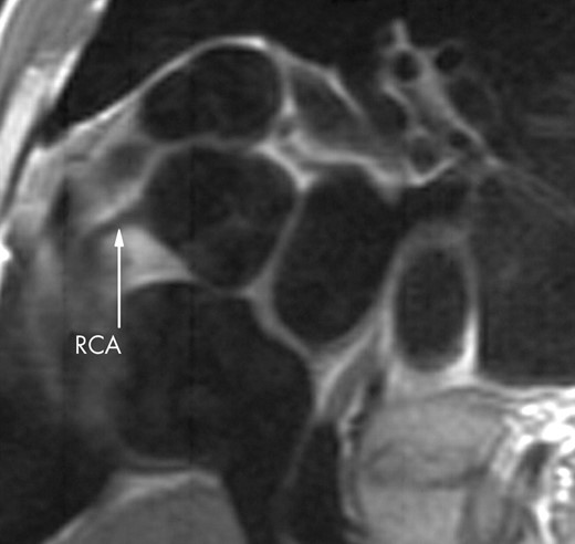 The proximal lumen of the right coronary artery is clearly seen.