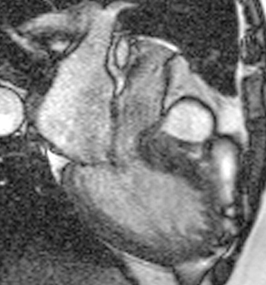 Hypertrophic obstructive cardiomyopathy. The asymmetrical septal thickening and obstruction to flow is clearly seen.