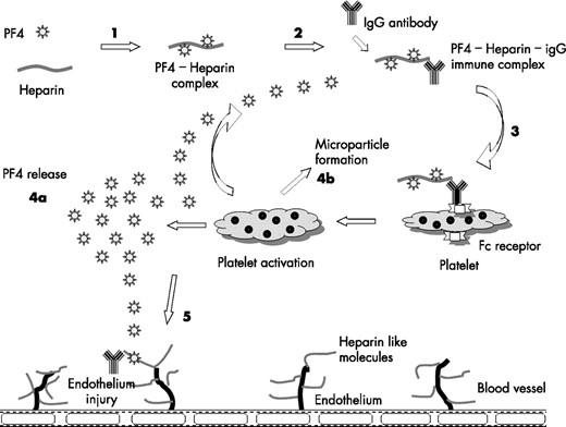 Pathophysiology of HIT. (1) Heparin binds with PF4 and act as immunogens. (2) IgG antibody thus produced forms PF4–heparin–IgG multimolecular complex. (3) The complex then binds via Fc receptor to platelets and activates them (4a) activated platelet releases additional PF4 and (4b) prothrombotic microparticles. (5) Immune complex interacts with endothelial cells and promotes immune mediated endothelial damage.