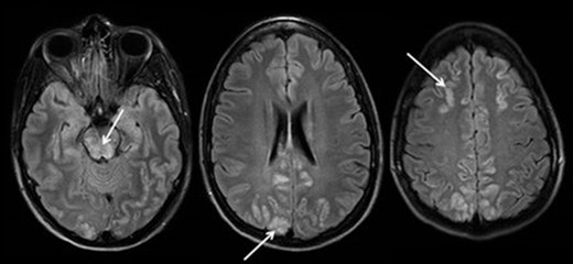MRI with T2-flair-weighted images showing the typically hyperintense bilateral lesions indicating vasogenic oedema in the parieto-occipital regions as well as less common lesions in the frontal regions and brain stem (arrows).27  28