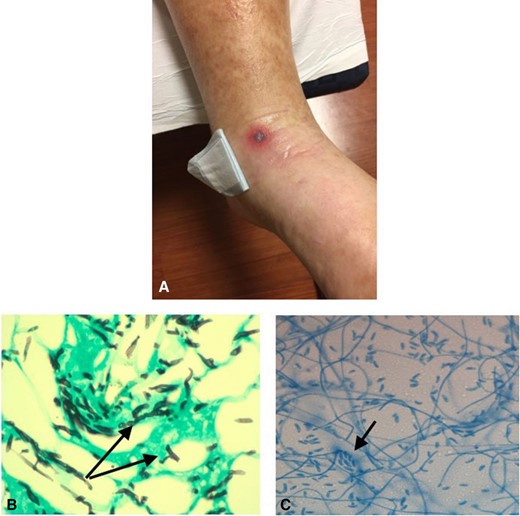 The patient developed a sudden skin lesion on the left dorsal foot, appearing as a flat 1 cm necrotic area with surrounding erythema (A). A Grocott-Gomori's methenamine silver stain at ×64 magnification revealed acute-angle branching septated hyphae with angioinvasive components (arrows) (B). A lactophenol cotton blue preparation at ×40 magnification demonstrated multiple macroconidia and microconidia (arrow) (C), consistent with a Fusarium species of mould.