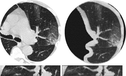 Comparisons between clinical CT lung images of a mild COVID-19 patient (left) and images of a corresponding 30 mm thick 3D-printed volumetric phantom (right), acquired with the same CT scanner and imaging parameters. Presented in two orthogonal views: axial (top), sagittal (bottom). Window level/width is −500/1,400 HU.