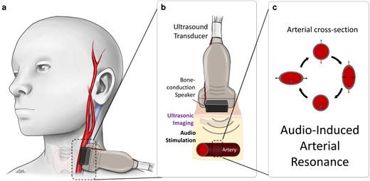 Acoustic stimulation paired with ultrasound imaging reveals resonance properties of an artery. a) Device placement to measure BP in the carotid artery. b) Illustration of device operation: ultrasound transducer (gray probe) is used to generate images of the artery (at bottom). Width of the transducer array (Acuson 6L3): 44 mm, transducer relative to the artery: 2–3.5 cm depth. The device provides acoustic stimulus via moving-coil drivers (black boxes) which induce arterial response. c) Illustration of RSM. If the frequency of the stimulus aligns with the resonant frequency of the artery, the artery's cross section oscillates between two forms (middle-left and middle-right), exaggerated for clarity. The top and bottom walls of the artery move relative to the ultrasound probe (motion toward and away from the probe are indicated as blue and red, respectively), which is captured by ultrasound imaging. Differential velocity of the walls (top velocity minus bottom velocity) is calculated. Comparing differential wall velocities over a range of stimulus frequencies enables identification of the resonant frequency.