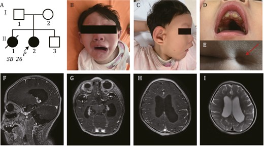 Pedigree of the family in this study. (A) Arrow indicates the proband. (B–D) Distinctive facial features presented by the proband. (B) Downturned “beaked” mouth of the proband (symmetric face at rest and asymmetric face while crying and laughing). (C) Metopic ridging and auricular deformity. (D) Oligodontia and narrow high arched palate were seen. (E) Red arrow indicates the sacral dimple of proband. (F–I) Brain MRI shows cerebral dysplasia, including agenesis of the corpus callosum (F), lateral ventriculomegaly (G), pachygyria (H) and decreased white matter of the lateral ventricle posterior horn (I).