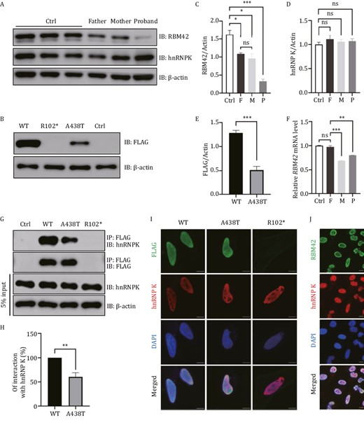 Expression of WT and variant RBM42 in different cell lines. (A) The expression of RBM42 and hnRNP K were measured in the lymphoblastoid cell lines (LCLs) of the index family and three healthy controls (Ctrl). Father: A438T/WT, Mother: R102*/WT, Proband: R102*/A438T. IB: Immunoblot. (B) 293T cells were transfected with 1 μg DNA of FLAG-tagged RBM42-WT, R102*, A438T or empty control (Ctrl). Expression of the transfected plasmids were detected at 48 h post-transfection by Western blot. (C) The densitometry value of endogenous RBM42 in LCLs were normalized to the amount of β-actin. Results are the mean ± SEM of three independent experiments. (D) The densitometry value of endogenous hnRNP K in LCLs was normalized to the amount of β-actin. Results are the mean ± SEM of three independent experiments. (E) The densitometry value of overexpression FLAG in 293T cells was normalized to the amount of β-actin. Results are the mean ± SEM of six independent experiments. (F) The mRNA level of RBM42 in peripheral blood leukocytes was measured by qRT-PCR and normalized to the expression of β-actin. Results are the mean ± SEM of three independent experiments. Using a healthy male as control (Ctrl). (G) 293T cells were transfected with 2.5 μg DNA of FLAG-tagged RBM42-WT, R102*, A438T or empty control (Ctrl). Immunoprecipitations were performed 48 h post-transfection and followed by Western blot analysis. (H) The densitometry values of co-immunoprecipitated endogenous hnRNP K were normalized to the amount of immunoprecipitated FLAG-RBM42-WT, or A438T. Results are the mean ± SEM of three independent experiments. (I) HeLacells were transfected with 1 μg DNA of FLAG-tagged RBM42-WT, A438T or R102*. Immunofluorescence was performed 48 h post-transfection. (J) Immunofluorescence results of endogenous RBM42 in untransfected HeLa cells. Scale bars: 10 μm. The statistical significance was determined using an unpaired Student’s t test. Data are considered significant when P values are < 0.05 (*), < 0.01(**), or < 0.001 (***).