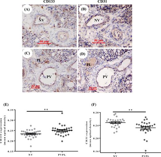 expression of angiogenic factors and plexiform lesions in the lungs adjacent sections of lung tissue from a 3 week old broiler showing immunohistochemical staining