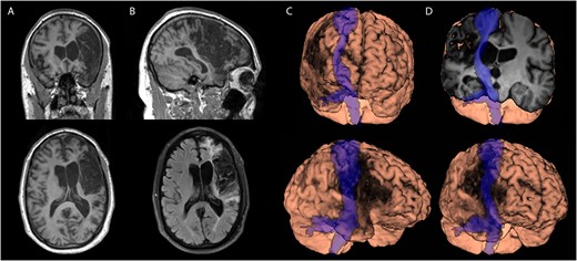Participant’s magnetic resonance imaging scan showing a large right middle cerebral artery stroke with cortical and subcortical involvement. The stroke overlapped with the corticospinal tract and motor cortex. There was adjacent lateral ventricle expansion but little evidence of widespread tissue atrophy or small vessel disease. (A) Longitudinal relaxation time (T1-weighted image) scan, coronal (top), and axial (bottom) views. (B) T1-weighted scan, sagittal (top), and axial fluid-attenuated inversion recovery (bottom) views. (C) and (D) Three-dimensional brain renderings in various planes showing the overlaid corticospinal tract in blue.