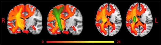 Overlap of Tract Disconnection Across Patients Without and With Corticospinal Tract (CST) Overlay. Red to yellow represents tract disconnection across patients. Green represents the CST. L = left; R = right.