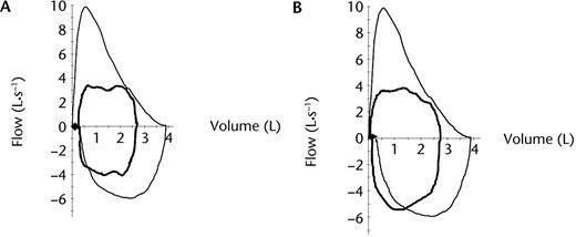 (A) Baseline flow-volume loops at rest (outer black line) and immediately prior to test completion when the patient chose to stand on the pedals to cycle (inner bold black line). ♦=inspiratory reserve volume immediately prior to test completion (∼250 mL). (B) Baseline flow-volume loops at rest (outer black line) and immediately prior to test completion with patient standing on the pedals to cycle (inner bold black line). ♦: inspiratory reserve volume immediately prior to test completion (∼80 mL).