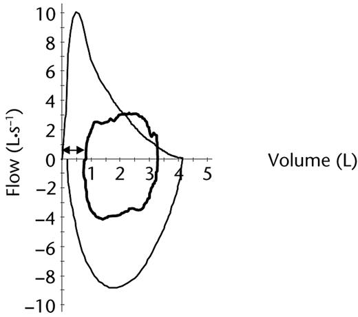 Posttraining flow-volume loops at rest (outer black line) and immediately prior to test completion (inner bold black line). ⇿=inspiratory reserve volume immediately prior to test completion (∼750 mL).