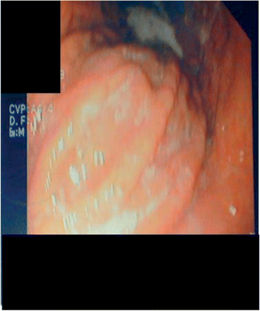 Gastroscopy showing granulomatous duodenal involvement