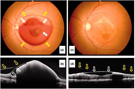 Fundus Photographs A Initial Visit C 3 Months Later Fundus Photographs A Initial Visit C 3 Months Later