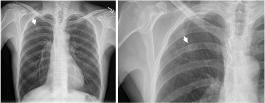 Chest x-ray showing an 1.5 cm multiform density nodular shadow in the right upper zone (arrow).