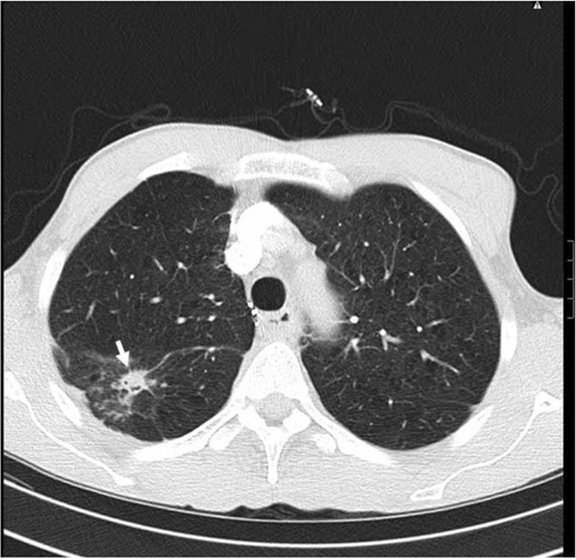 CT scan of the chest, lung window, showing 1.5 cm irregular solitary nodular shadow in the upper segment of right lower lobe (arrow). There is no associated hilar or mediastinal lymph nodes enlargement.