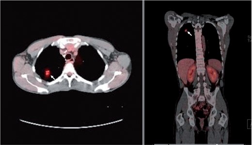 Fused PET/CT scan of the chest. Axial (left panel) and coronal (right panel) images showing moderately increased uptake (FDG uptake with SUV of 3.8) in the right lung nodular lesion (arrows).