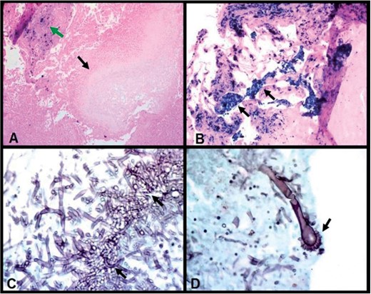 Wedge resection histopathology of the right lung nodule demonstrates pulmonary siderosis and aspergilloma. (A) Cavity containing pale-staining proliferating fungal hyphae (lower arrow) (fungal ball—aspergilloma, a size of 2 mm in diameter) with iron staining in adjacent fibrous scar (upper arrow) (Prussian blue iron stain, 100×). (B) Dense interstitial fibrosis containing clusters and sheets of macrophages with cytoplasmic bright blue iron pigment (arrows) (Prussian blue iron stain, 200×). (C) Medium-power photomicrograph shows clusters of acute angle branching fungal hyphae of aspergillus fumigatus (arrows) (Grocott Methenamine Silver-GMS stain, 400×). (D) High-power photomicrograph demonstrates aspergillus fumigatus conidiophore with classic fruiting head (arrow). (GMS stain, 630×).