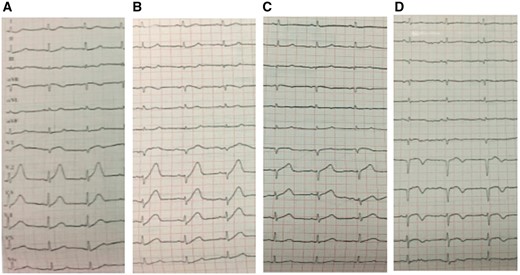 (A) Electrocardiogram performed approximately 70 min after onset of pain. (B) Electrocardiogram at the 3rd h with persisting ischemic pain. (C) Electrocardiogram 1 h after the thrombolytic therapy. (D) Electrocardiogram after the PCI.