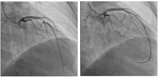 Cardiac catheterization showing a 90% stenosis of the middle of the left anterior descending (left) and after a drug-eluting stent placement (right).