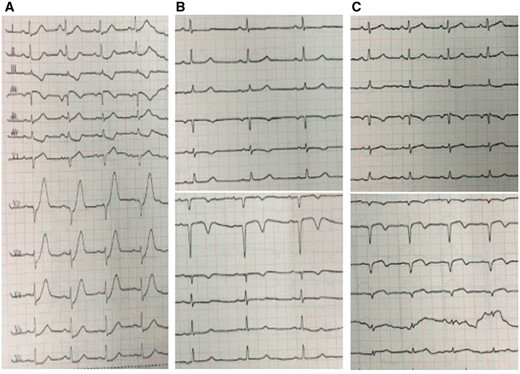 (A) Electrocardiogram at the 3 h after onset of pain. (B) Electrocardiogram 2 h after the thrombolytic therapy. (C) Electrocardiogram after the PCI.