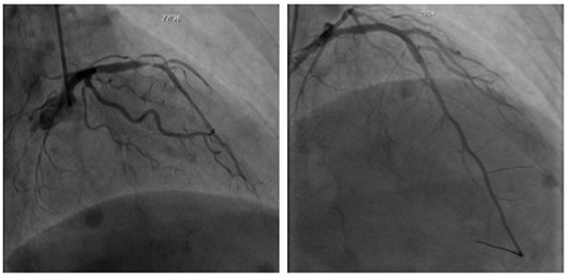 Cardiac catheterization showing a 90% stenosis of the proximal left anterior descending artery and a 90% stenosis of the proximal first diagonal branch (left) and after two drug-eluting stents placement (right).