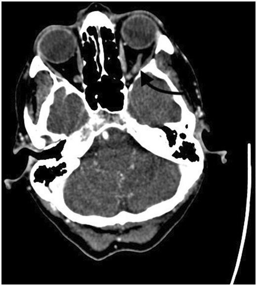 (a) Axial pre-contrast study shows left inferior ophthalmic vein hyperdensity and expansion and (b) post-contrast study confirming lack of contrast filling in left inferior ophthalmic vein.