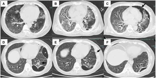 Computed tomography (CT) images during the course of hospitalization. (A) CT image at hospitalization shows the presence of bilateral ground-glass opacities. (B) CT image on hospital day (HD) 25. The ground-glass opacities in the bilateral lung fields had expanded, indicating exacerbation of interstitial pneumonia. (C) CT image on HD 35. One additional drain was placed in the ventral pneumothorax cavity (arrow) because the single drain placed dorsally was insufficient for degassing. (D) CT image on HD 77. The air leak did not disappear despite endobronchial occlusion of branches of the left lower lobe (arrow). (E) CT image on HD 92. Autologous blood patch pleurodesis resulted in disappearance of the ventral pneumothorax cavity (arrow). (F) CT image on HD 100. The air leak from the dorsal drain had stopped, and the drain was removed.