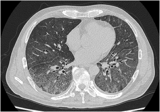 Chest CT on the day of admission showing diffuse ground glass opacity bilaterally.