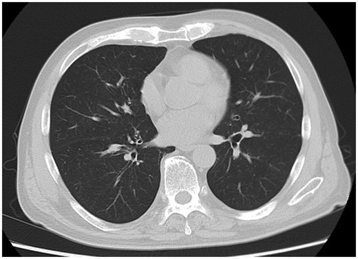 Chest CT 39 days after admission showing improvement in lung shadow.