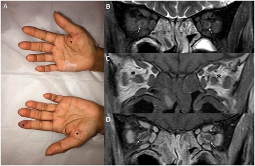 Purpuric macules in hands (A) (arrowheads) and, MRI orbital coronal T2 (B), pre (C) and post (D) contrast-enhanced T1-weighted images demonstrating extensive naso-ethmoidal sinusitis and retrobulbar inflammatory stranding (asterisks) centered around the peri-optic neuritis (arrows) compared to normal fat signal in the superomedial extraconal spaces.