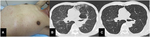 (A) Photographs of the patient’s trunk with maculopapular rash. (B) Chest CT showed bilateral interstitial infiltrate, ground glass opacities, interlobular septal thickening and consolidation. (C) Repeat chest CT showed that radiographic abnormalities were vanished after the treatment.