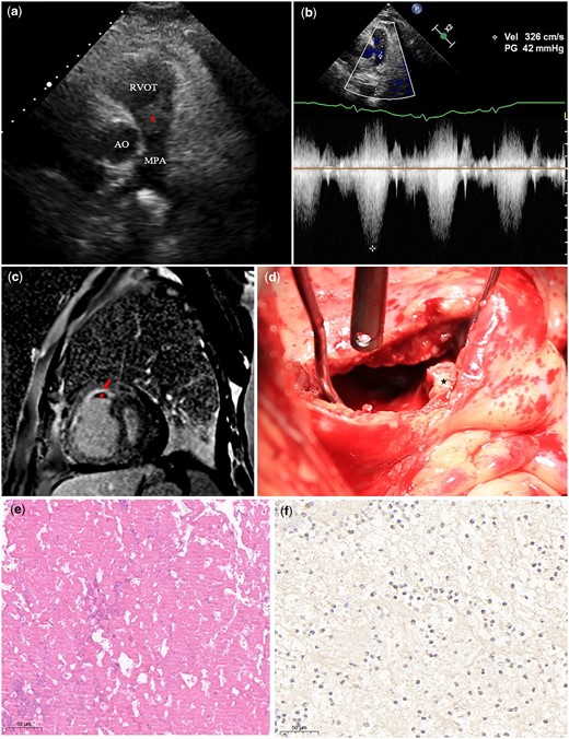 (a) Two-dimensional transthoracic echocardiography shows a hypoechoic mass (asterisk) presenting within the RVOT. (b) Continuous wave Doppler reveals a high velocity jet across the right ventricular outflow tract (obstruction). (c) The delayed gadolinium enhanced CMR images reveal a mass (asterisk) with no enhancement and subendocardial enhancement of the right ventricle (red arrow). (d) Intraoperative image shows a dense mass in RVOT before resection (asterisk). (e) Hematoxylin–eosin stain shows that the mass is composed of trabecular platelets and red blood cell (×20). (f) Immunostaining against the eosinophilic cationic protein confirmed that the adjacent cardiac muscle is infiltrated by a large amount of eosinophil. AO, aorta; MPA, main pulmonary artery; RVOT, right ventricular outflow tract.