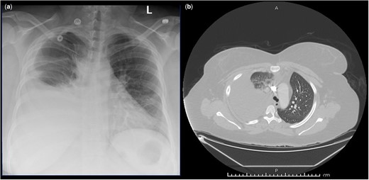 (a) Chest X-ray showing a new moderate right-sided pleural effusion with adjacent opacities likely representing subsegmental atelectasis. (b) Computed tomography angiogram showing a large right-sided pleural effusion with adjacent compressive atelectasis of the right upper, middle and lower lobes; mild subsegmental atelectasis in the left lung base.