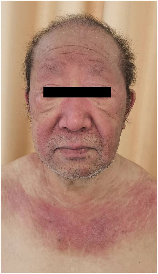 Heliotrope rash over the upper eyelids, extending downwards along the nasolabial sulcus and V-neck sign rash.