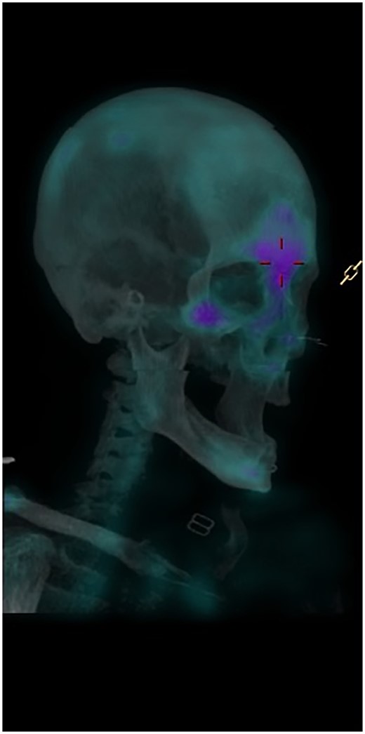 Sinonasal and mandibular aeras uptake of 99mtechnetium methylene diphosphonate bone scintigraphy.