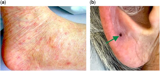 (a) Non-pruritic maculopapular rash on her left sole. (b) An eschar was located on her right earlobe, which indicated the site of an infected chigger bite (arrow).