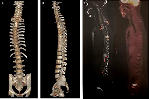 Osteosclerosis in Castleman's disease (A,B) Three dimensional reconstruction of whole spine CT showed multiple abnormal high-density shadows in spine, thorax and pelvis. (C) 18F-FDG P ET / CT showed multiple osteogenic changes in multiple vertebral bodies and accessories of the spine, and there was no increase in metabolism.